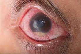 glaucomoa